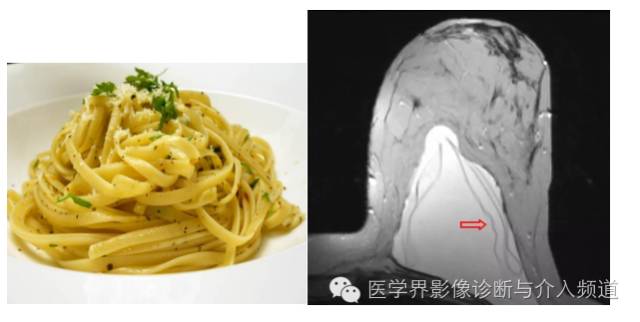 盘点：那些形象而有趣的影像学征象