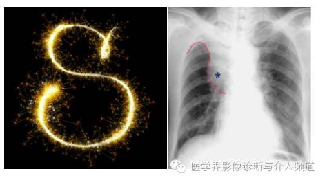 盘点：那些形象而有趣的影像学征象
