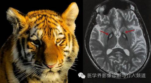 盘点：那些形象而有趣的影像学征象