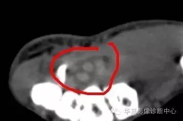 腕管综合征
