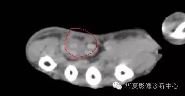 腕管综合征 腕管综合征