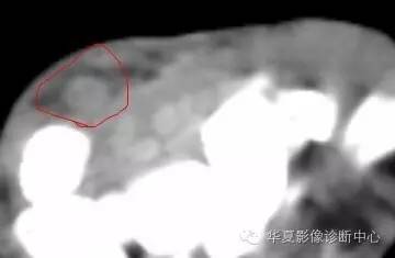 腕管综合征 腕管综合征