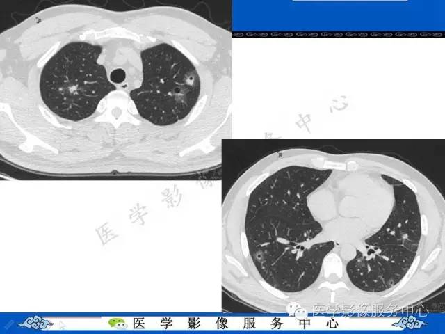 【病例】肺血管肉瘤1例CT影像表现