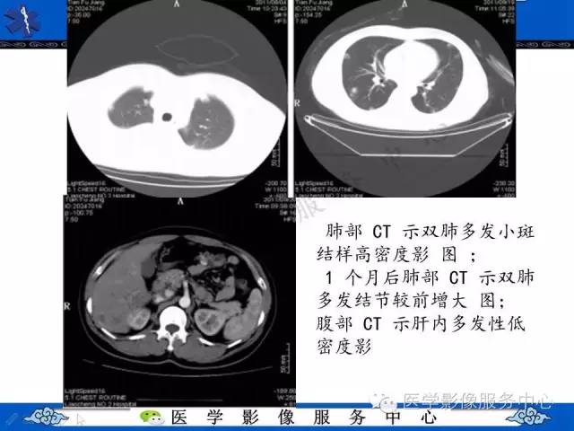 【病例】肺血管肉瘤1例CT影像表现