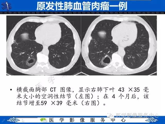 【病例】肺血管肉瘤1例CT影像表现