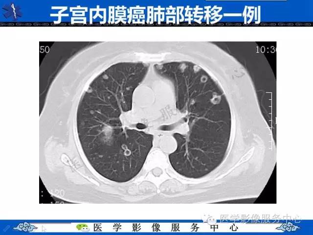 【病例】肺血管肉瘤1例CT影像表现