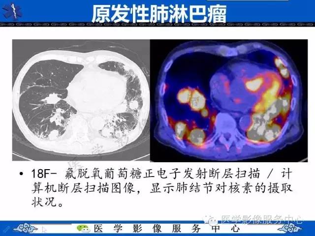 【病例】肺血管肉瘤1例CT影像表现