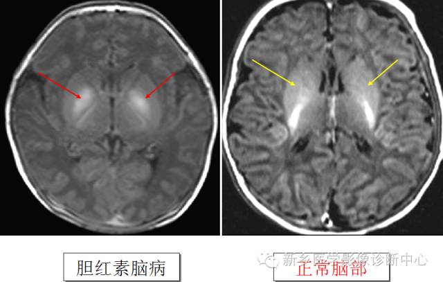 一个不容易诊断的疾病——胆红素脑病 一个不容易诊断的疾病——胆红素脑病