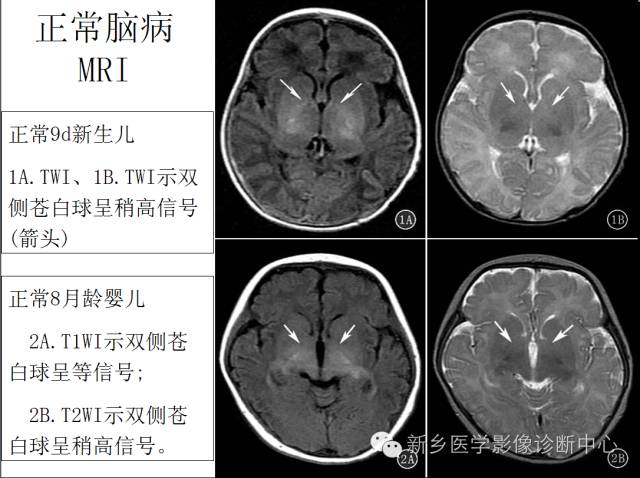 一个不容易诊断的疾病——胆红素脑病 一个不容易诊断的疾病——胆红素脑病