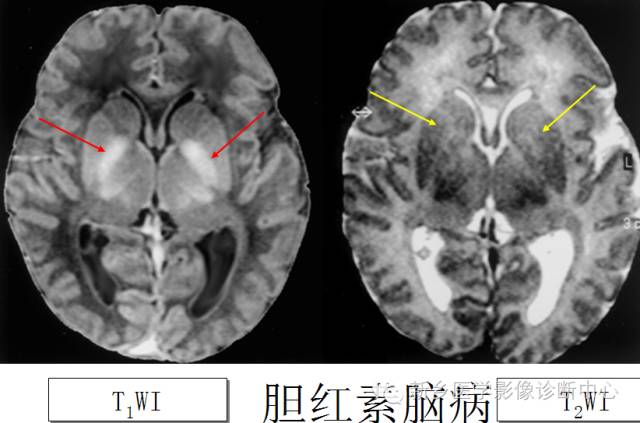 一个不容易诊断的疾病——胆红素脑病 一个不容易诊断的疾病——胆红素脑病