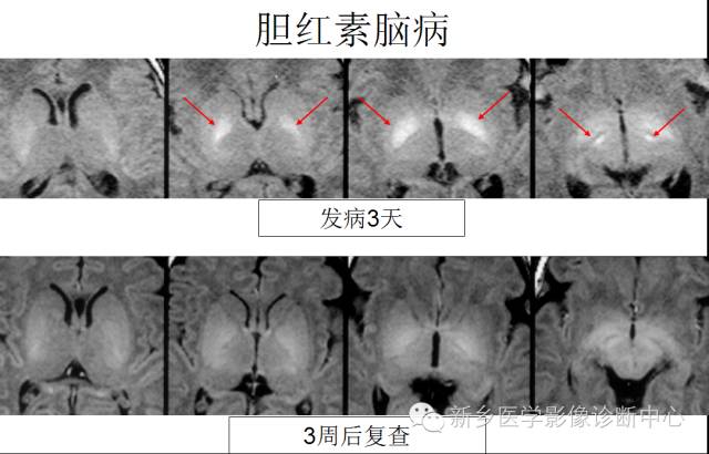 一个不容易诊断的疾病——胆红素脑病 一个不容易诊断的疾病——胆红素脑病