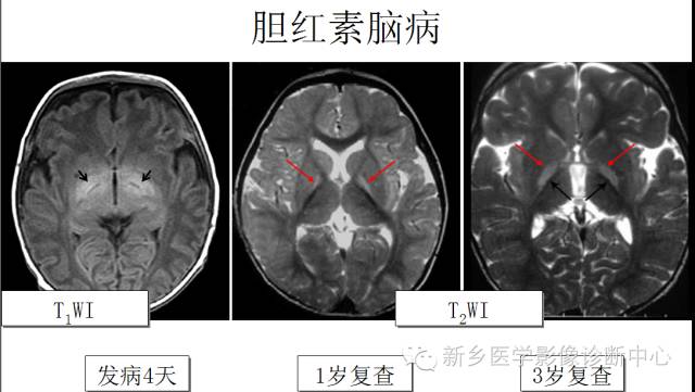 一个不容易诊断的疾病——胆红素脑病 一个不容易诊断的疾病——胆红素脑病