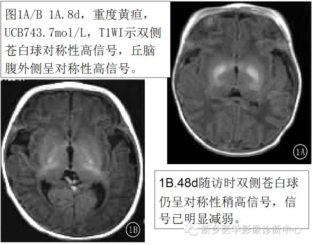 一个不容易诊断的疾病——胆红素脑病 一个不容易诊断的疾病——胆红素脑病