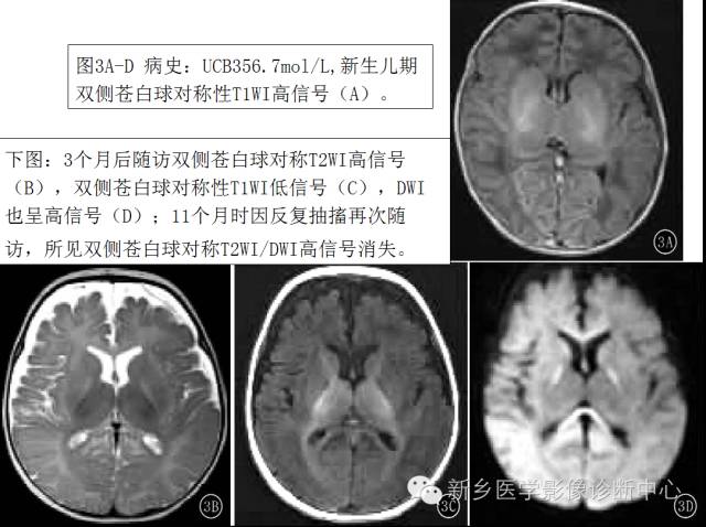 一个不容易诊断的疾病——胆红素脑病 一个不容易诊断的疾病——胆红素脑病