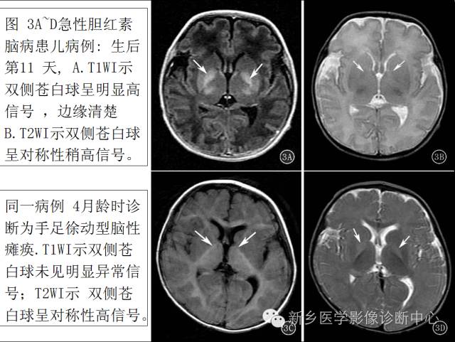一个不容易诊断的疾病——胆红素脑病 一个不容易诊断的疾病——胆红素脑病