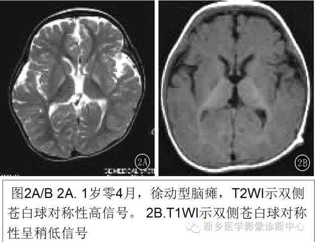 一个不容易诊断的疾病——胆红素脑病 一个不容易诊断的疾病——胆红素脑病