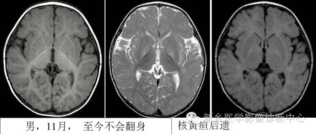 一个不容易诊断的疾病——胆红素脑病