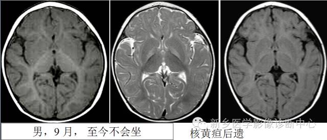 一个不容易诊断的疾病——胆红素脑病 一个不容易诊断的疾病——胆红素脑病
