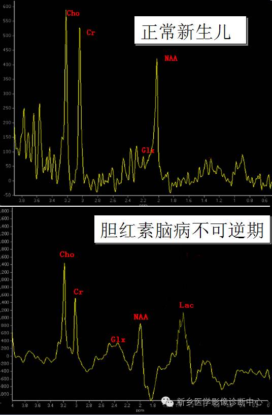 一个不容易诊断的疾病——胆红素脑病 一个不容易诊断的疾病——胆红素脑病