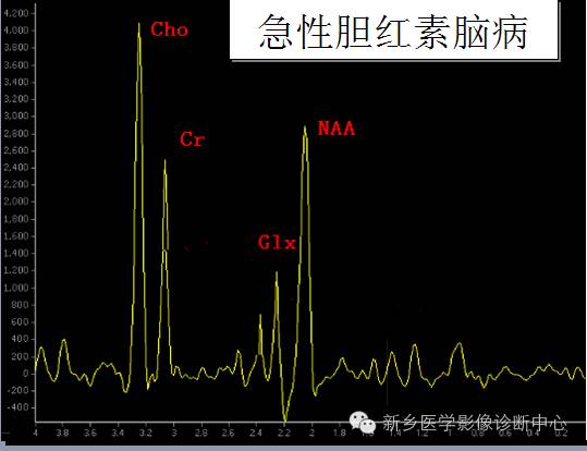 一个不容易诊断的疾病——胆红素脑病 一个不容易诊断的疾病——胆红素脑病