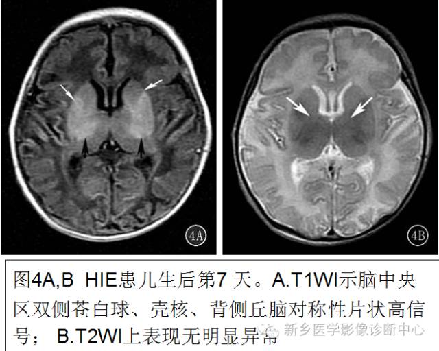 一个不容易诊断的疾病——胆红素脑病 一个不容易诊断的疾病——胆红素脑病