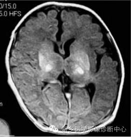 一个不容易诊断的疾病——胆红素脑病 一个不容易诊断的疾病——胆红素脑病