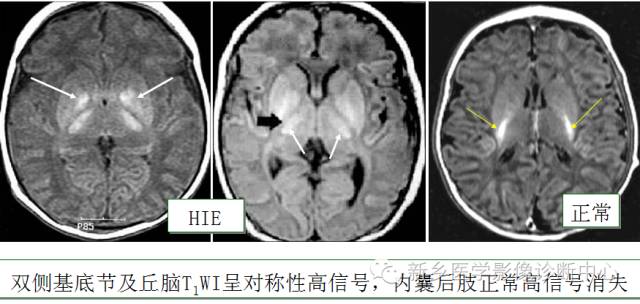 一个不容易诊断的疾病——胆红素脑病 一个不容易诊断的疾病——胆红素脑病