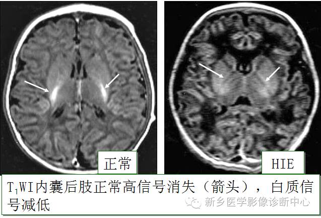 一个不容易诊断的疾病——胆红素脑病 一个不容易诊断的疾病——胆红素脑病