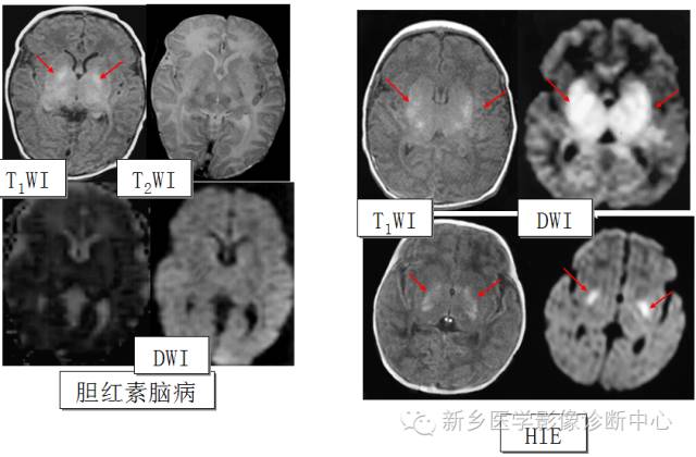 一个不容易诊断的疾病——胆红素脑病 一个不容易诊断的疾病——胆红素脑病