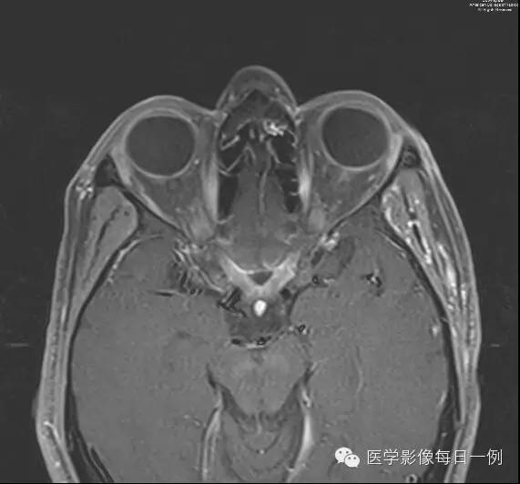 【病例】视神经脊髓炎1例MR影像表现