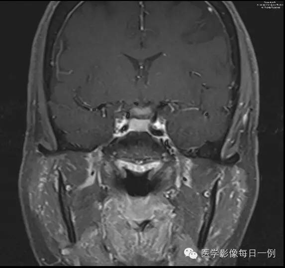 【病例】视神经脊髓炎1例MR影像表现 【病例】视神经脊髓炎1例MR影像表现