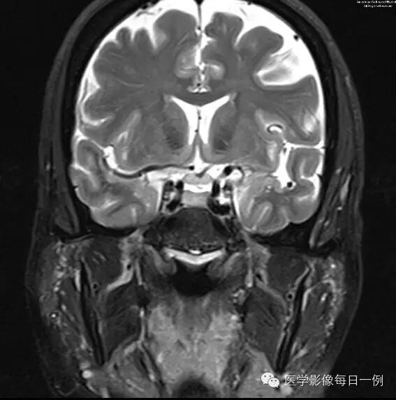 【病例】视神经脊髓炎1例MR影像表现 【病例】视神经脊髓炎1例MR影像表现