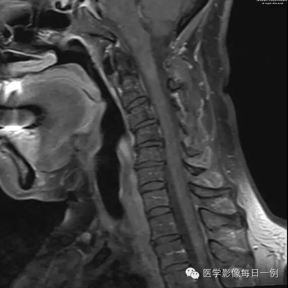 【病例】视神经脊髓炎1例MR影像表现 【病例】视神经脊髓炎1例MR影像表现
