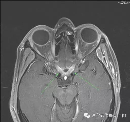 【病例】视神经脊髓炎1例MR影像表现 【病例】视神经脊髓炎1例MR影像表现