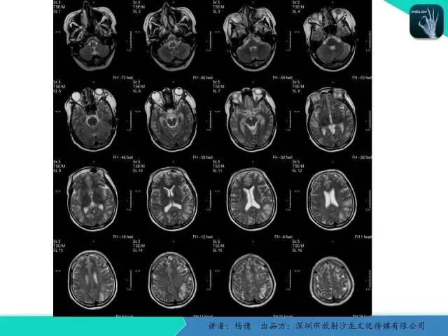 【病例】低血糖脑病一例MR影像表现