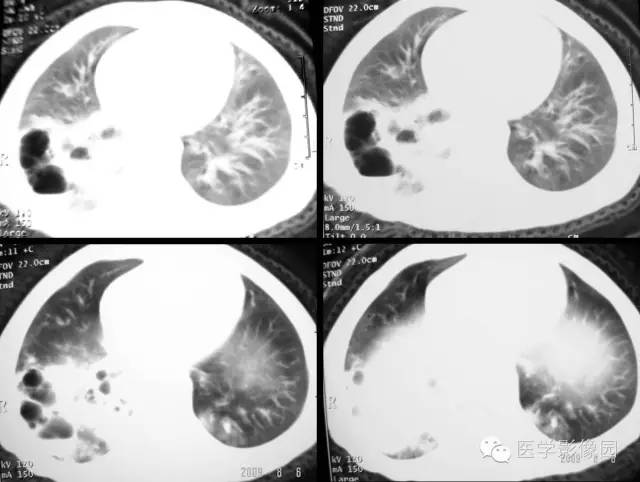 【病例】先天性囊性腺瘤样畸形1例CT影像表现