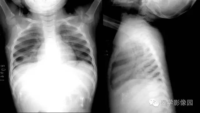 【病例】先天性囊性腺瘤样畸形1例CT影像表现