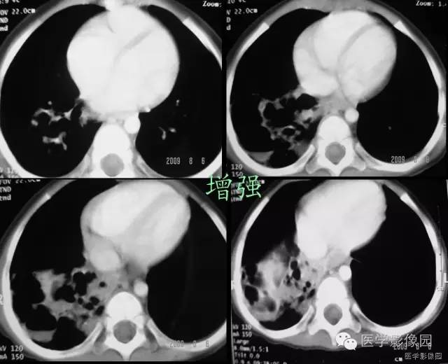【病例】先天性囊性腺瘤样畸形1例CT影像表现