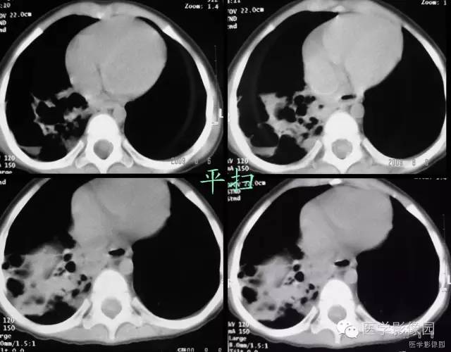 【病例】先天性囊性腺瘤样畸形1例CT影像表现