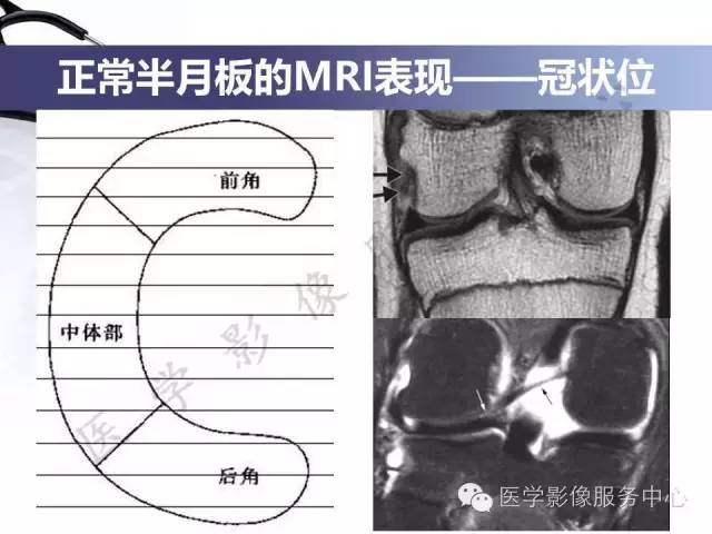 【PPT】半月板病变的MRI诊断