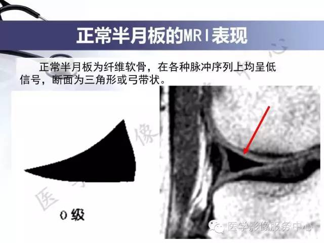 【PPT】半月板病变的MRI诊断
