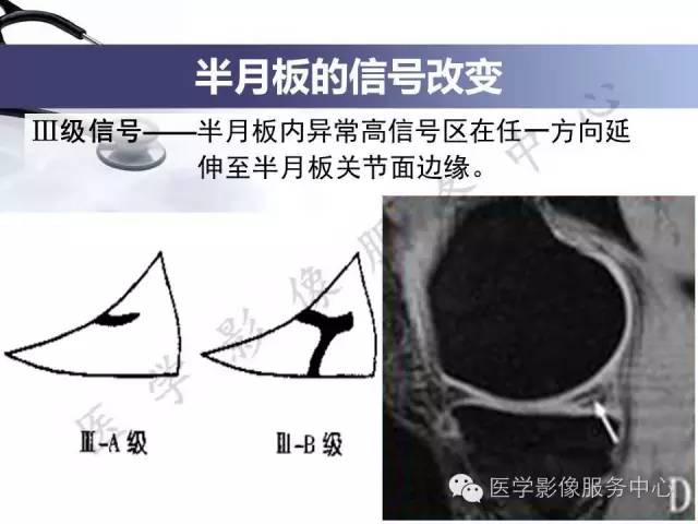 【PPT】半月板病变的MRI诊断