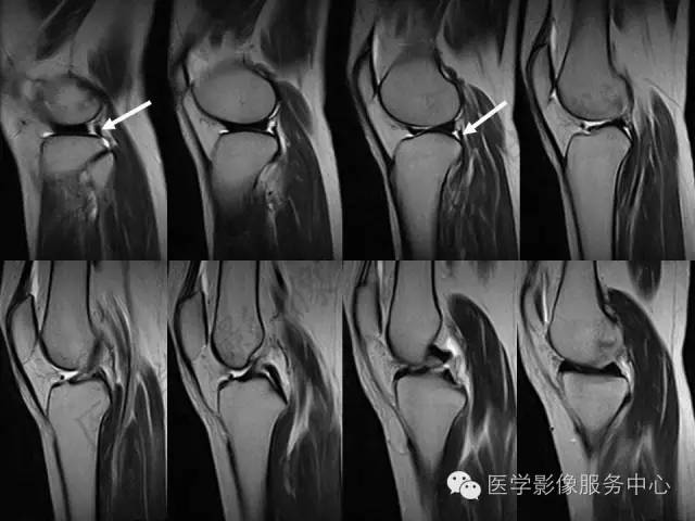 【PPT】半月板病变的MRI诊断