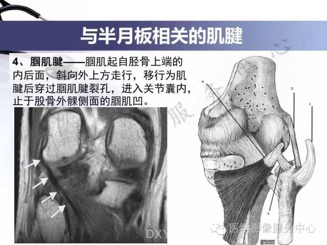 【PPT】半月板病变的MRI诊断