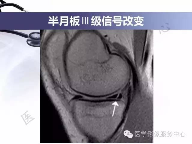 【PPT】半月板病变的MRI诊断