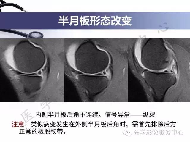 【PPT】半月板病变的MRI诊断
