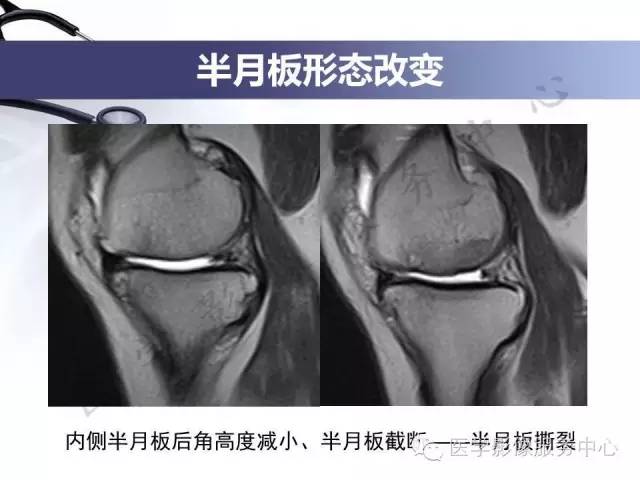 【PPT】半月板病变的MRI诊断