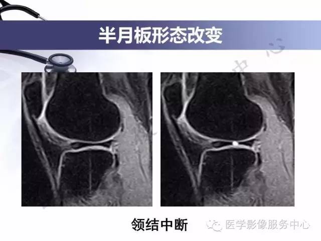 【PPT】半月板病变的MRI诊断