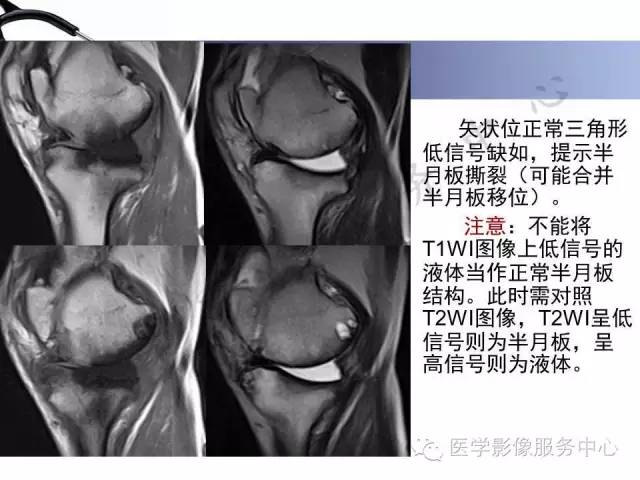 【PPT】半月板病变的MRI诊断