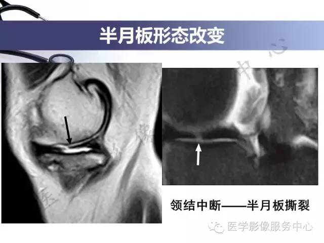 【PPT】半月板病变的MRI诊断